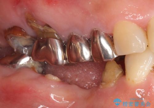 骨が薄く他院でインプラントできないと言われた 50代女性の治療前