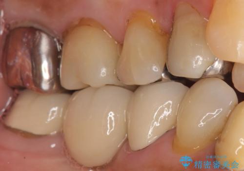 歯磨きすると痛い 不適合なクラウンのやりかえ 70代女性の治療前