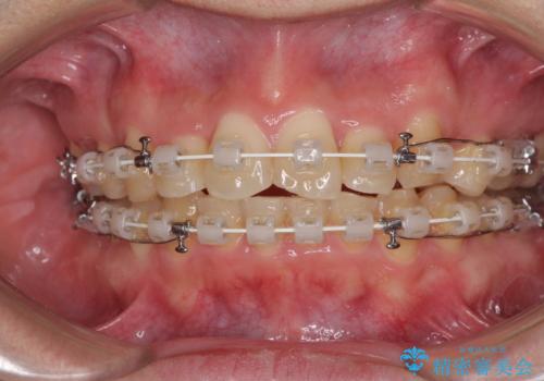強い咬み込みですり減った前歯　デコボコを抜歯矯正で整えるの治療中