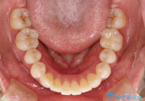 ワイヤー矯正とオールセラミックの組み合わせ治療の治療後