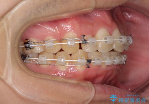 強い咬み込みですり減った前歯 デコボコを抜歯矯正で整えるの治療中