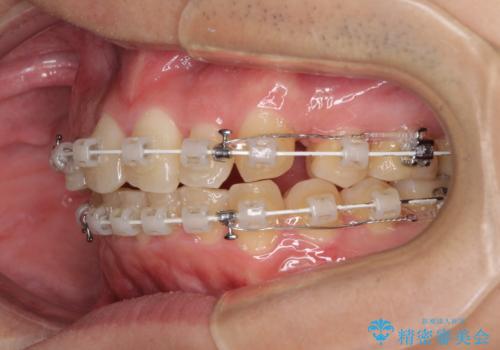 強い咬み込みですり減った前歯 デコボコを抜歯矯正で整えるの治療中