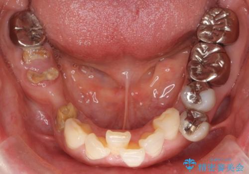 骨が薄く他院でインプラントできないと言われた 50代女性の治療前