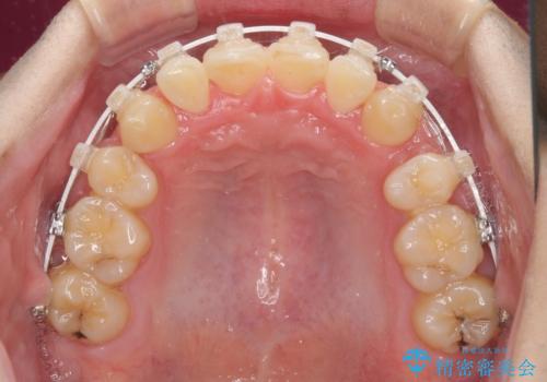 強い咬み込みですり減った前歯 デコボコを抜歯矯正で整えるの治療中