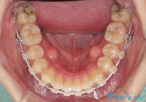 強い咬み込みですり減った前歯 デコボコを抜歯矯正で整えるの治療中