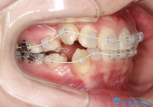 八重歯が気になる ワイヤーによる抜歯矯正できれいな歯並びへの治療中