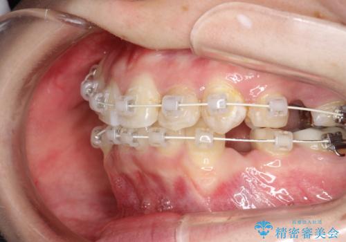 八重歯が気になる　ワイヤーによる抜歯矯正できれいな歯並びへの治療中