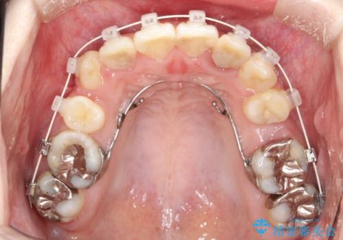 八重歯が気になる ワイヤーによる抜歯矯正できれいな歯並びへの治療中