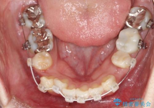 八重歯が気になる ワイヤーによる抜歯矯正できれいな歯並びへの治療中