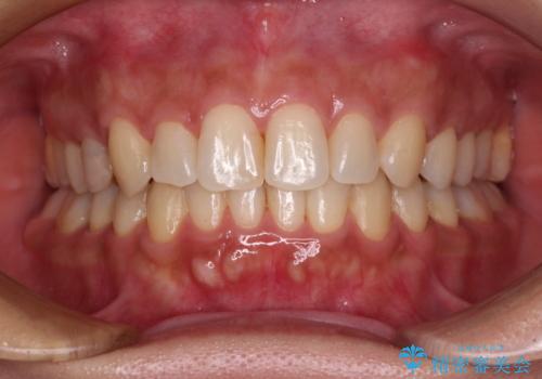 沖縄から飛行機で通院 インビザラインによる矯正治療の治療後