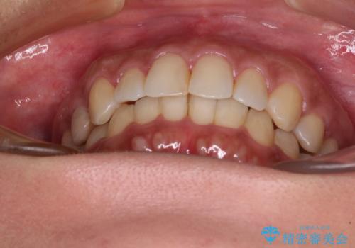 沖縄から飛行機で通院 インビザラインによる矯正治療の治療後