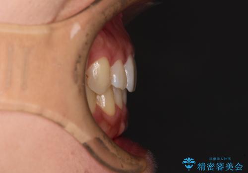 沖縄から飛行機で通院 インビザラインによる矯正治療の治療後