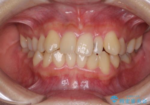 八重歯の抜歯矯正　補助装置を用いたインビザライン矯正の症例 治療前