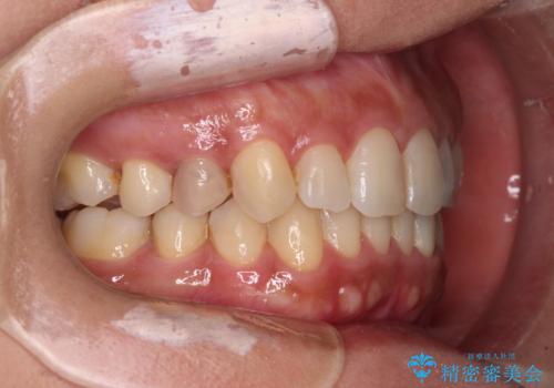 沖縄から飛行機で通院 インビザラインによる矯正治療の治療後