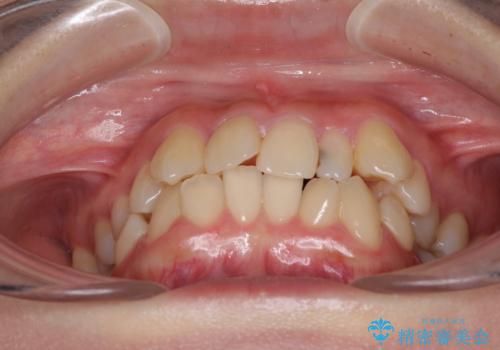 八重歯の抜歯矯正 補助装置を用いたインビザライン矯正の治療前