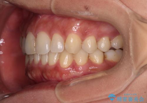 沖縄から飛行機で通院 インビザラインによる矯正治療の治療後