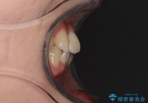 八重歯の抜歯矯正 補助装置を用いたインビザライン矯正の治療前