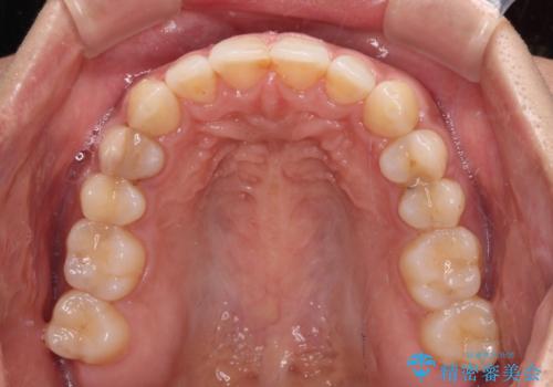 沖縄から飛行機で通院 インビザラインによる矯正治療の治療後