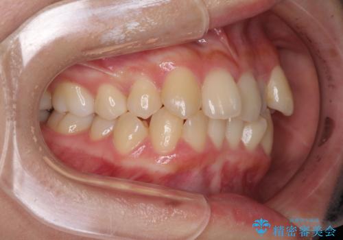 八重歯の抜歯矯正 補助装置を用いたインビザライン矯正の治療前