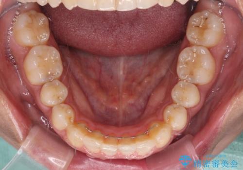 沖縄から飛行機で通院 インビザラインによる矯正治療の治療後
