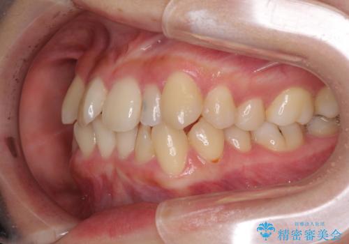 八重歯の抜歯矯正 補助装置を用いたインビザライン矯正の治療前