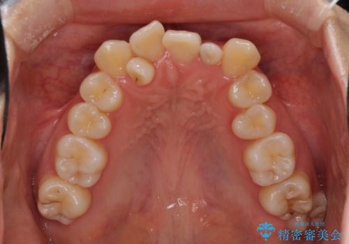 八重歯の抜歯矯正 補助装置を用いたインビザライン矯正の治療前