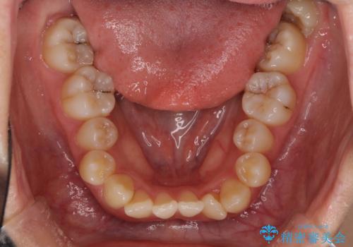 八重歯の抜歯矯正 補助装置を用いたインビザライン矯正の治療前