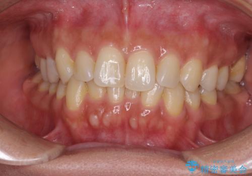 沖縄から飛行機で通院 インビザラインによる矯正治療の治療前