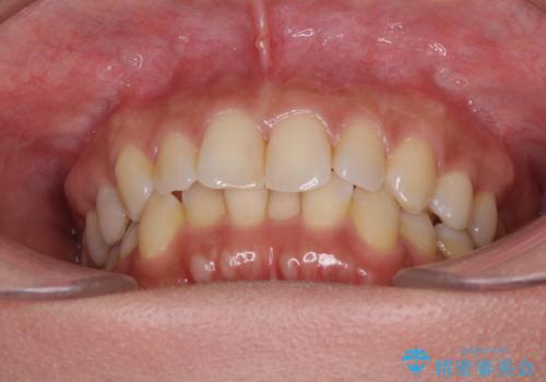 沖縄から飛行機で通院 インビザラインによる矯正治療の治療前