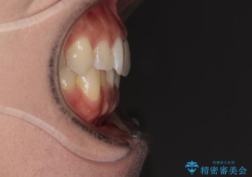 沖縄から飛行機で通院 インビザラインによる矯正治療の治療前