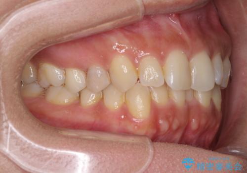 沖縄から飛行機で通院 インビザラインによる矯正治療の治療前