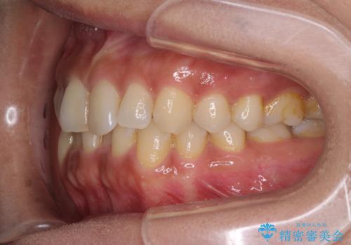 沖縄から飛行機で通院 インビザラインによる矯正治療の治療前