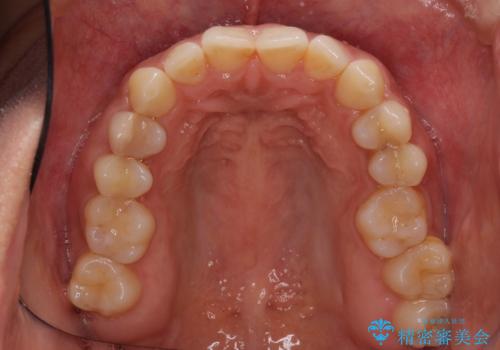 沖縄から飛行機で通院 インビザラインによる矯正治療の治療前