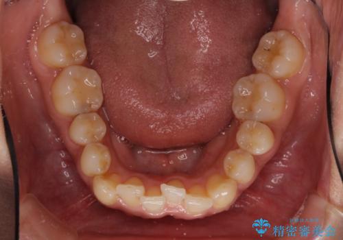 沖縄から飛行機で通院 インビザラインによる矯正治療の治療前