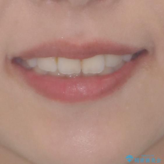 上顎の八重歯と下顎前歯の欠損 ワイヤー装置による抜歯矯正の治療後(顔貌)