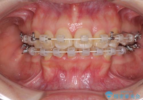 飛び出した前歯を引っ込めたい 目立たないワイヤーでの抜歯矯正の治療中