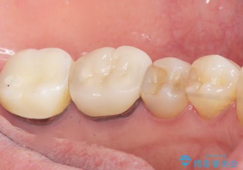 詰め物の境目が黒くて気になる 40代女性の治療前