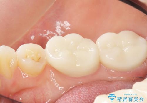 奥歯の隙間を治したい 矯正は嫌 30代女性の治療後