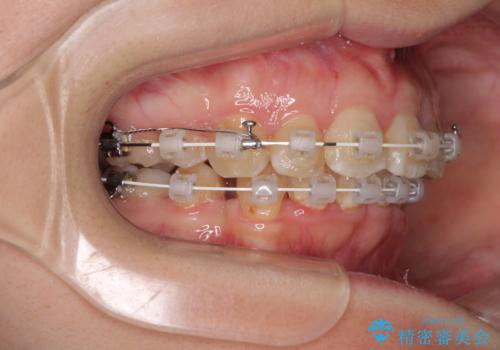 飛び出した前歯を引っ込めたい 目立たないワイヤーでの抜歯矯正の治療中