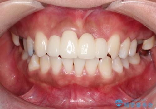 3年間仮歯 前歯セラミックブリッジの治療後