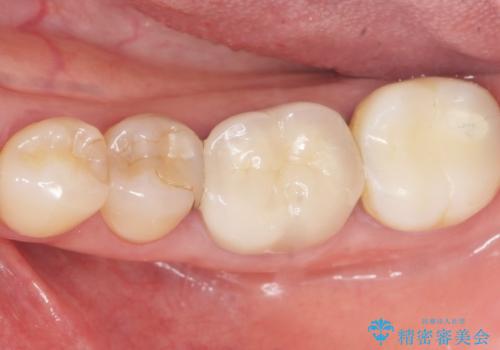 詰め物の境目が黒くて気になる 40代女性の治療前