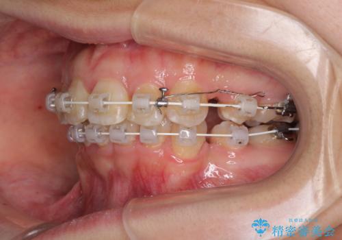 飛び出した前歯を引っ込めたい 目立たないワイヤーでの抜歯矯正の治療中