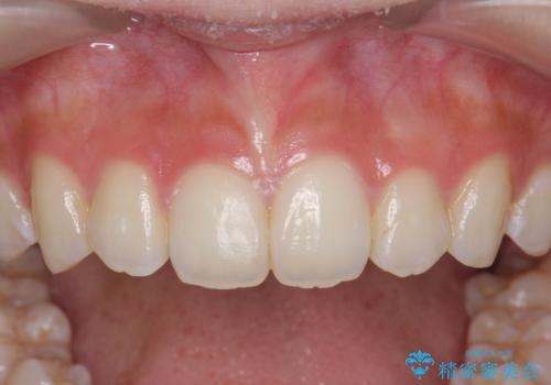 インビザラインライトで行う短期マウスピース矯正治療の治療後