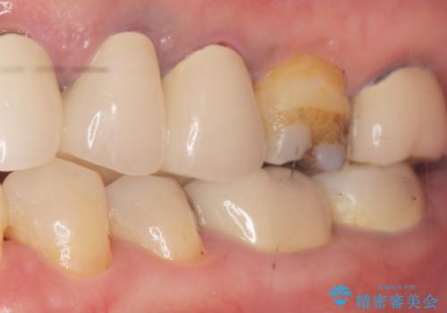 詰め物の境目が黒くて気になる 40代女性の治療前