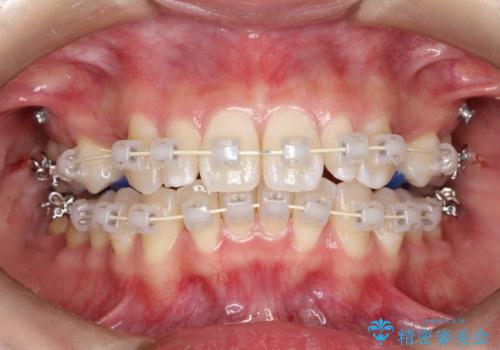 ワイヤー矯正とオールセラミックの組み合わせ治療の治療中