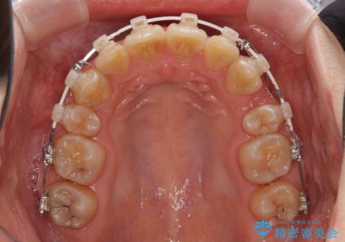 飛び出した前歯を引っ込めたい 目立たないワイヤーでの抜歯矯正の治療中