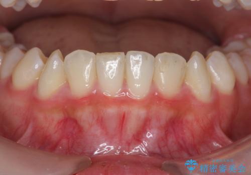 インビザラインライトで行う短期マウスピース矯正治療の治療後