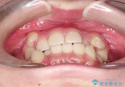 八重歯が気になる　ワイヤーによる抜歯矯正できれいな歯並びへの治療前