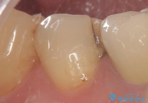 詰め物の境目が黒くて気になる 40代女性の治療前