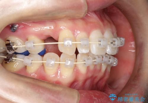 ワイヤー矯正とオールセラミックの組み合わせ治療の治療中